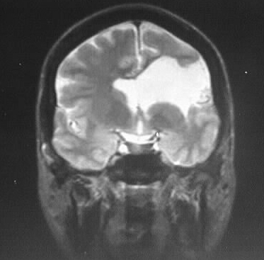 Open Lipped Schizencephaly